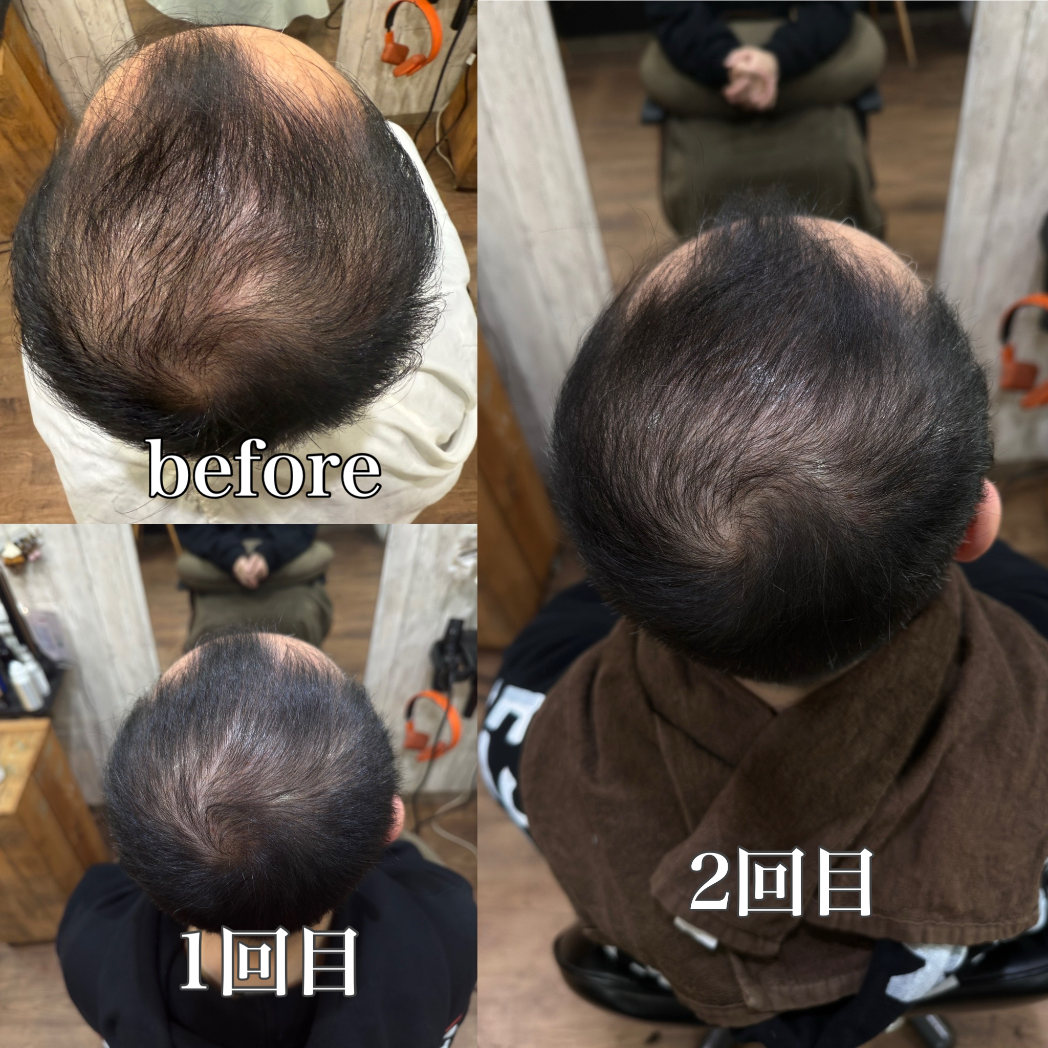 【大阪　今里】エクソソーム（整肌成分）ヘアエステで頭皮環境を整え、エイジングケアができる！？