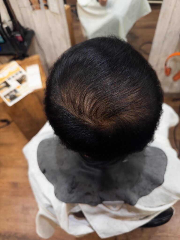 複数回のエクソソームをしての頭皮と髪の毛の変化