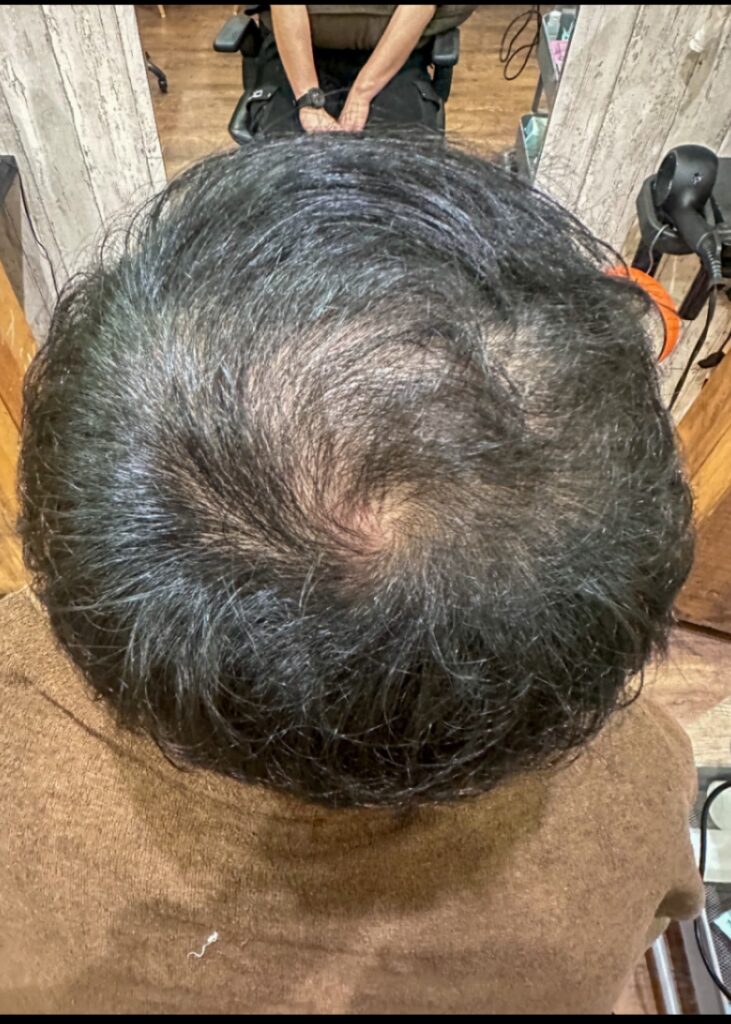 エクソソームエステをする前