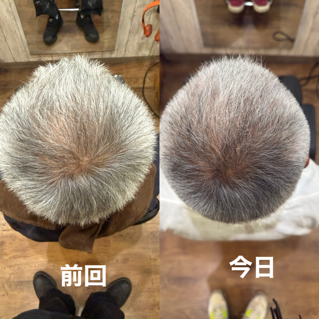 1ヶ月後の髪の毛の変化。白髪が黒い髪の毛になってきてます