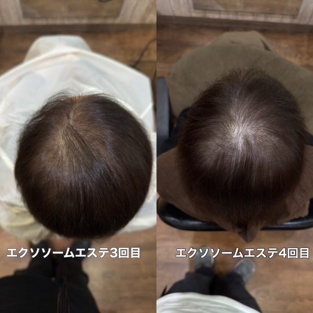 エクソソーム育毛エステの1ヶ月で髪の毛と頭皮の変化
