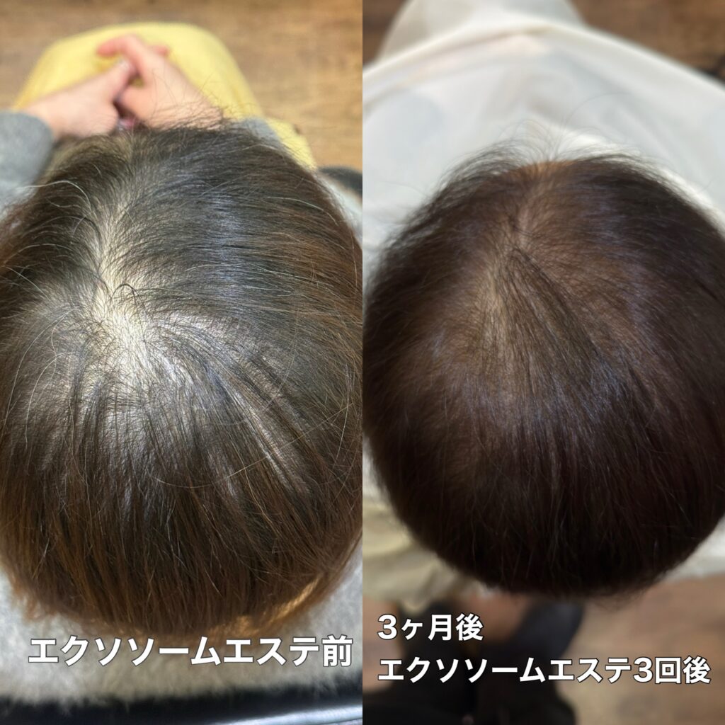 エクソソーム育毛エステの施術前と施術後の変化