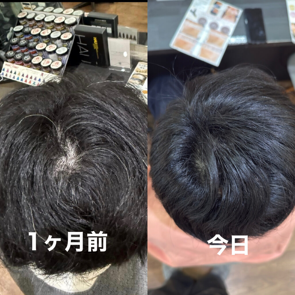     エクソソーム施術前後の頭頂部の比較写真