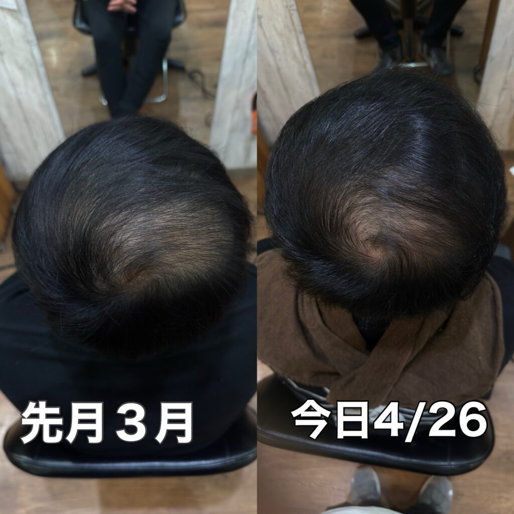エクソソーム育毛エステの施術後にホームケアとしてエクソソームの化粧水、HAUヘアパックを継続されたお客様の頭皮の変化
