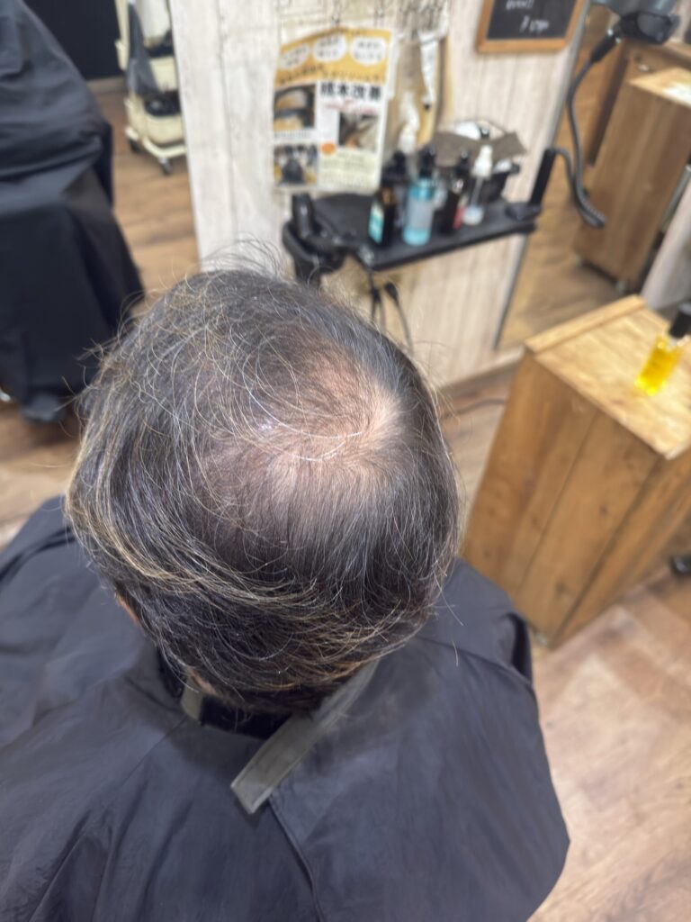 頭頂部がエイジング毛で、特に細くなっている男性
