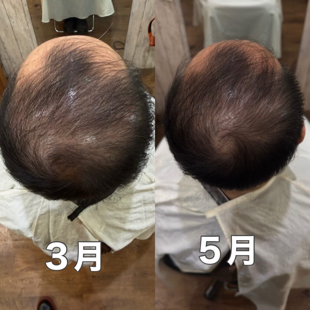 2ヶ月のエクソソーム育毛エステの変化