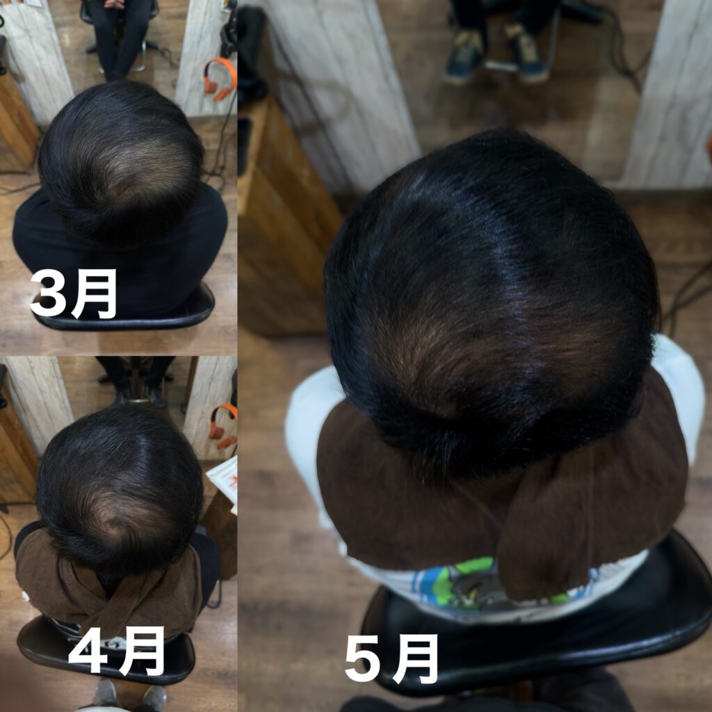 画像 エクソソーム育毛の変化