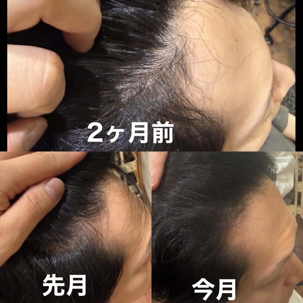 2ヶ月間で生え際の髪の毛がエクソソーム施術で増えた写真