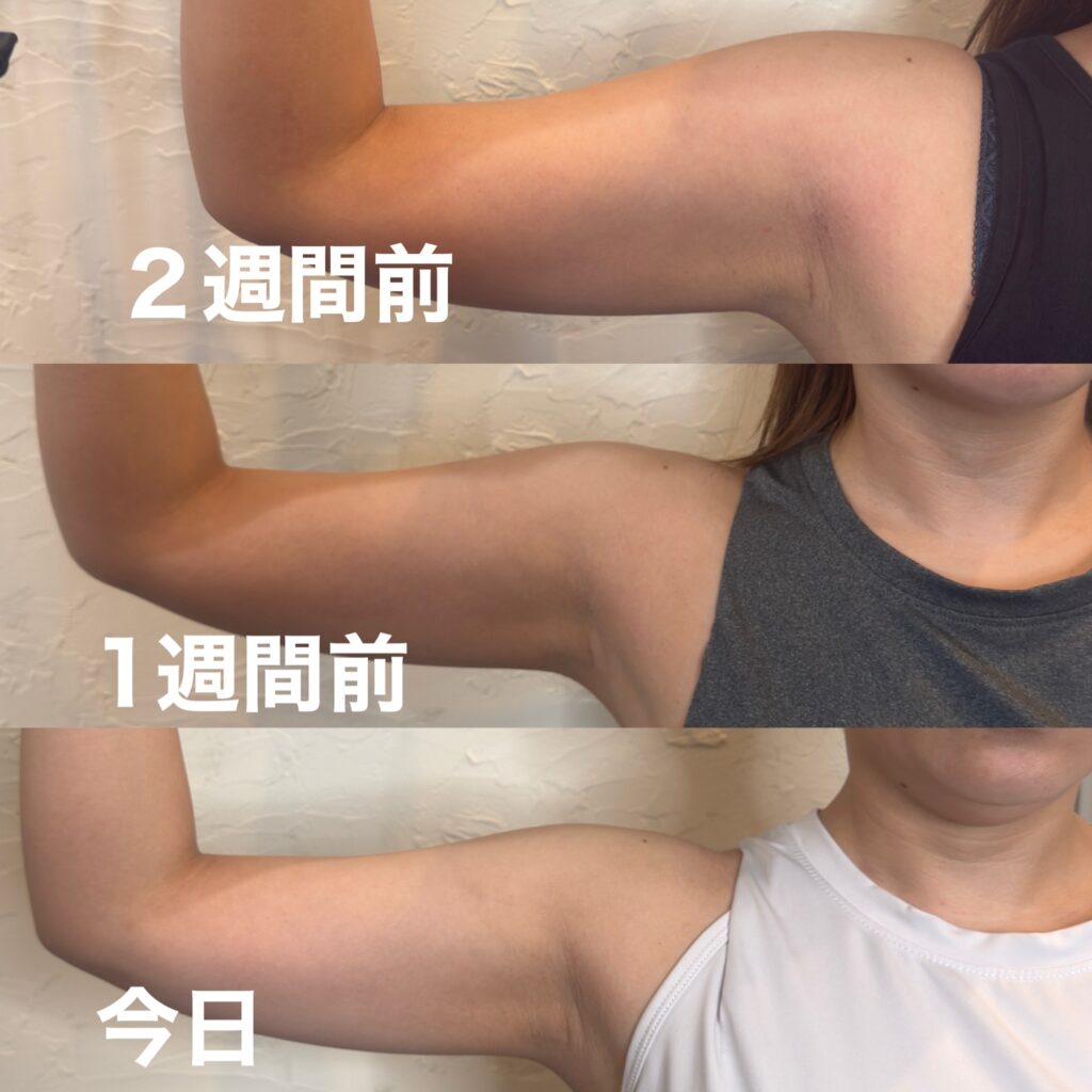 画像 デポロエステの1ヶ月の腕の変化
