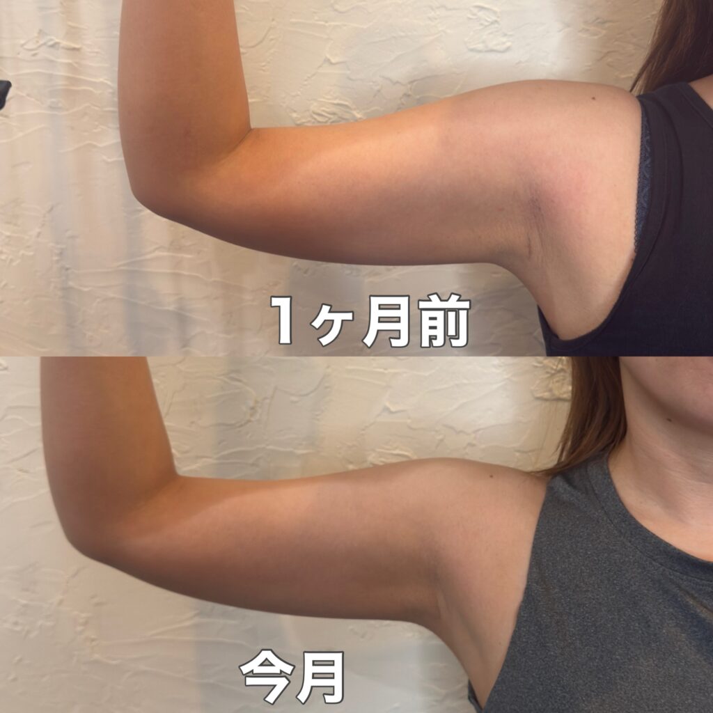 前から見たデポロエステの1ヶ月の二の腕の変化
