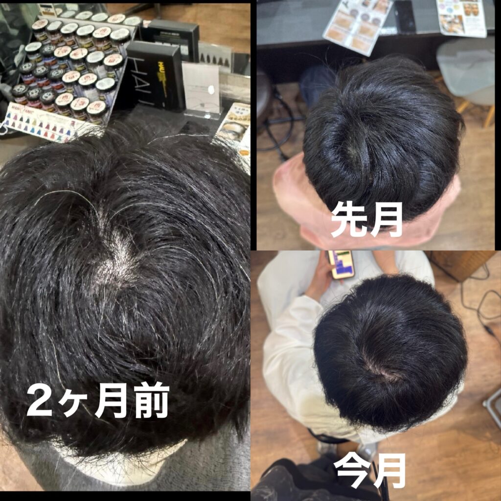頭頂部のエクソソーム育毛エステ、2ヶ月の結果