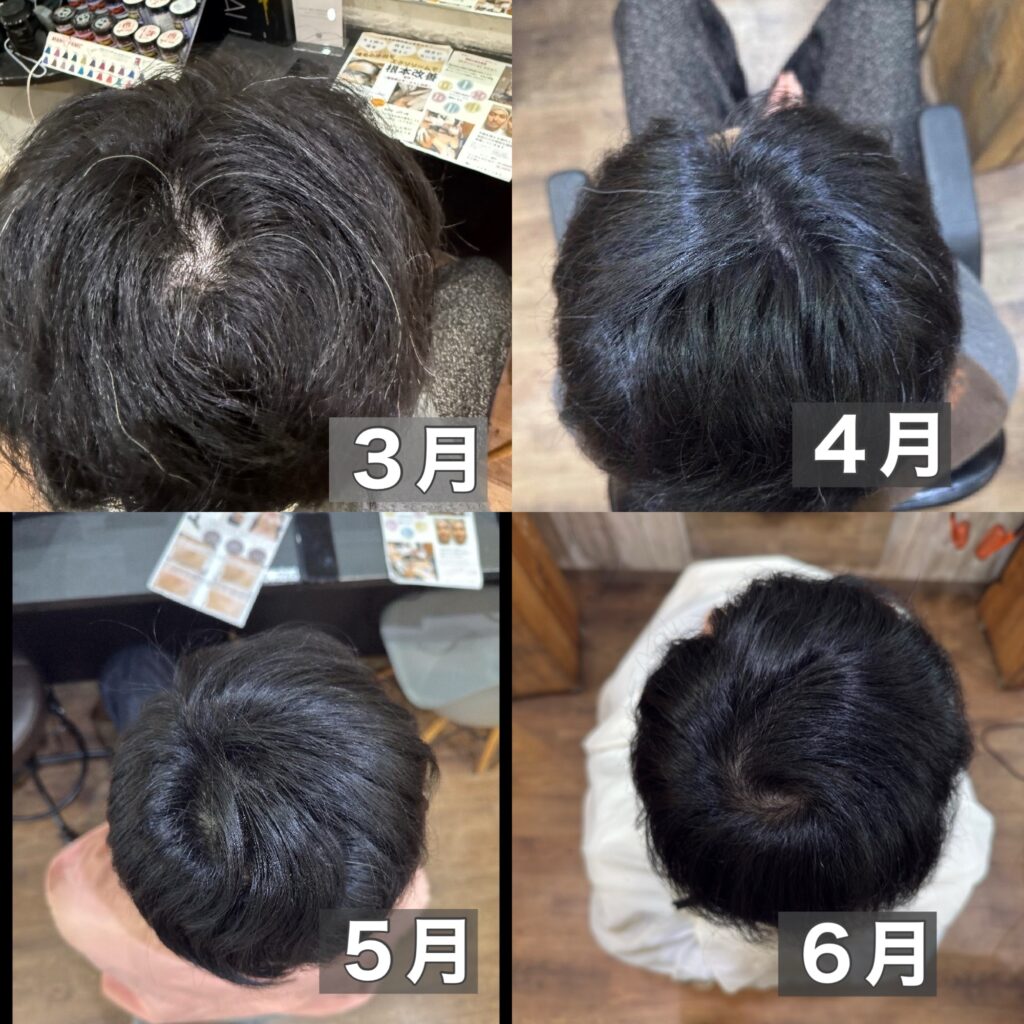 頭頂部の３ヶ月の育毛結果