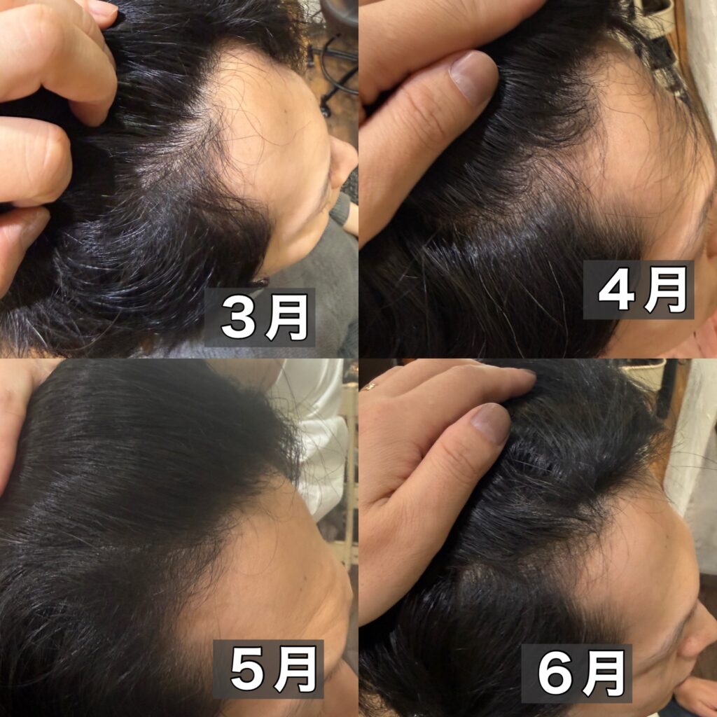 ３ヶ月の前髪の育毛結果
