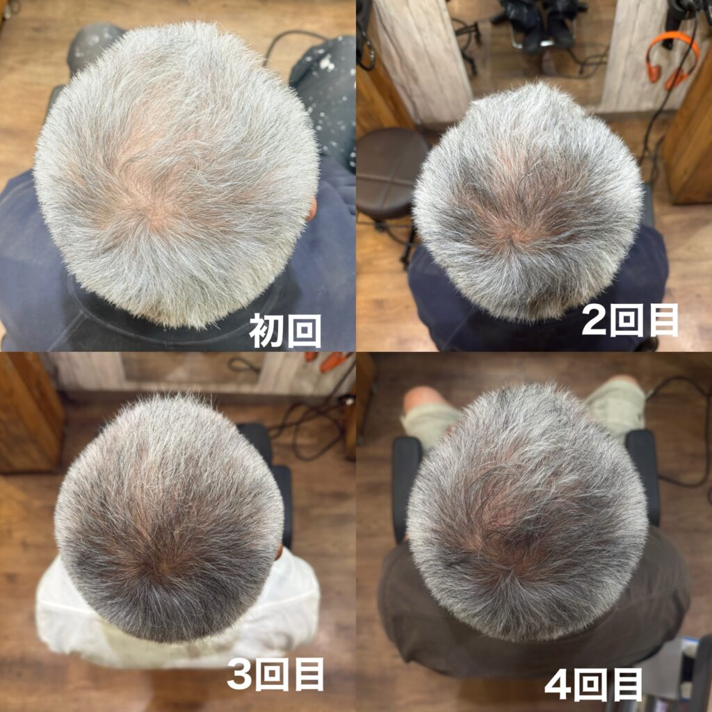 エクソソームエステ4回の結果