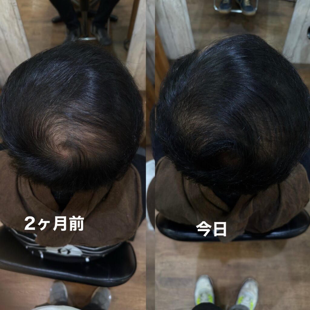 エクソソーム育毛エステでの2ヶ月の差