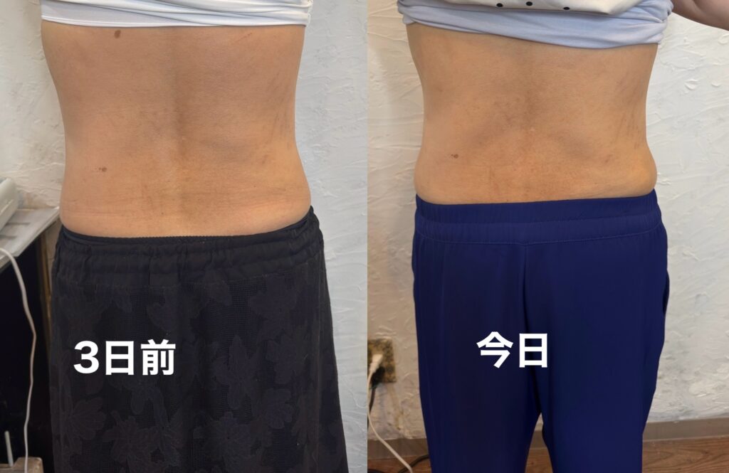 デポロエステで少しくびれができてきた