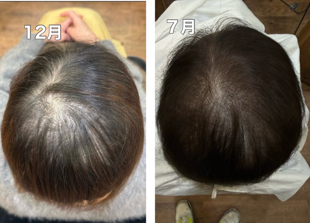 画像 育毛エクソソーム
