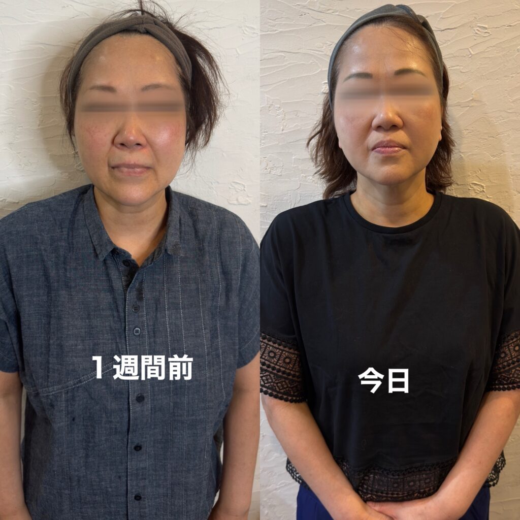 デポロエステの結果