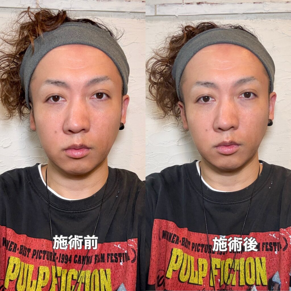 47才エクソソームエステの結果