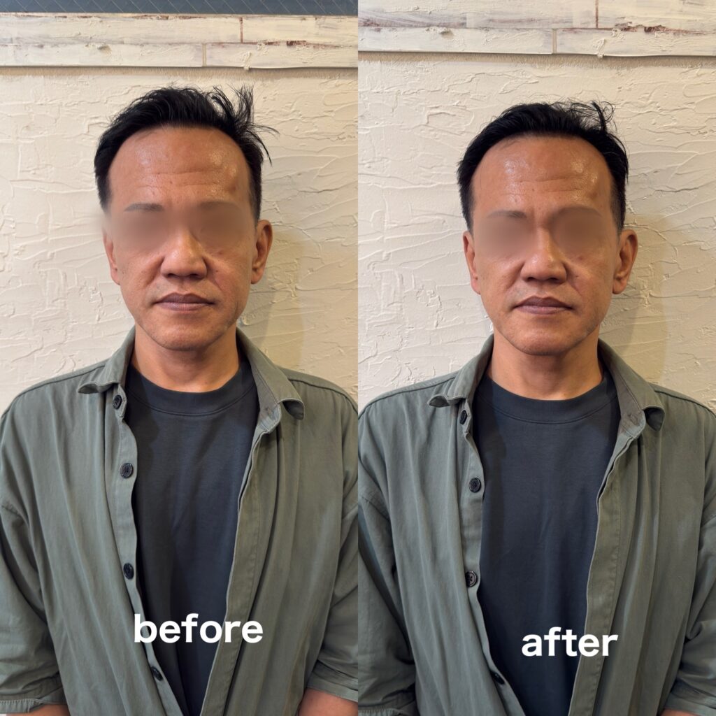 50代男性エクソソームエステ
